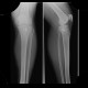 Tibia foreign body gun shot wound: X-ray - Plain radiograph